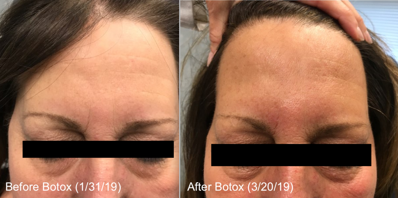 B Trezza Before and After Botox with Dates