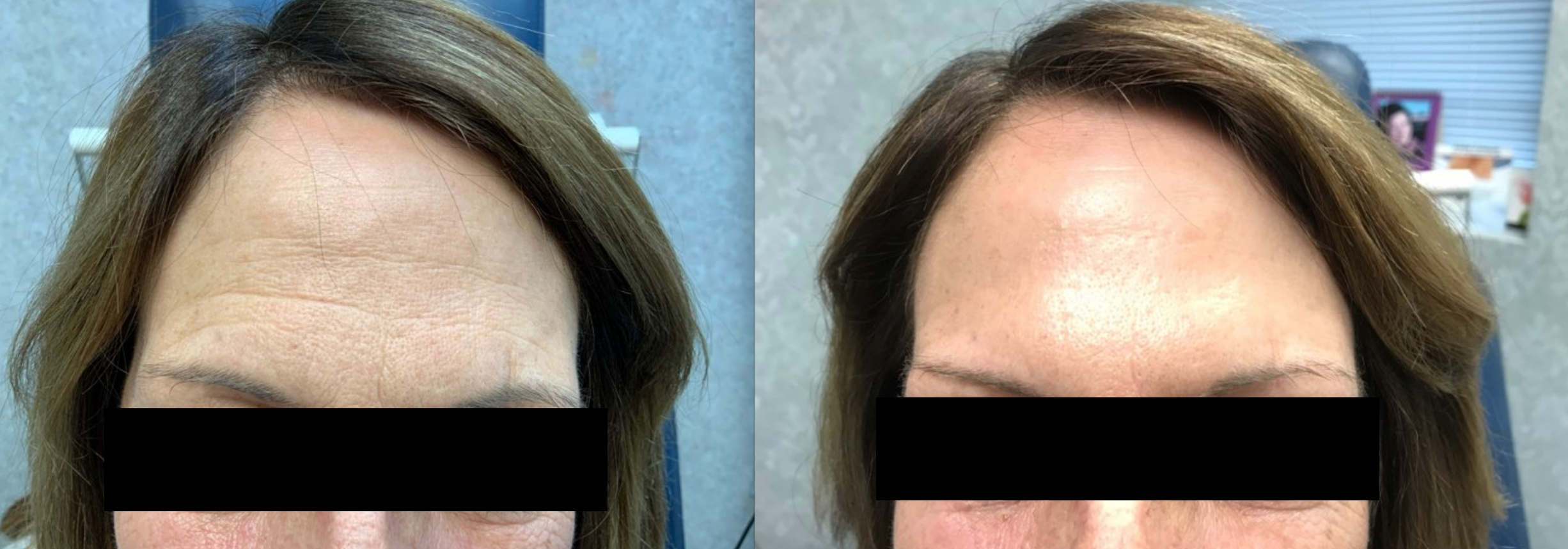 D Reinsch Before and After Botox_