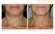 ultherapy-0008-0086w_before-180daysafter_neck