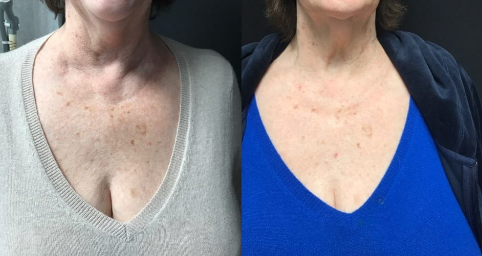Ultherapy Before_After