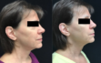 ultherapy b&a