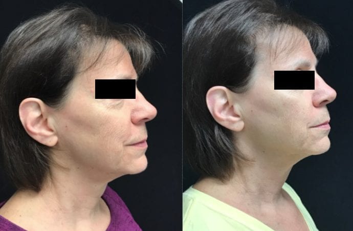 ultherapy b&a